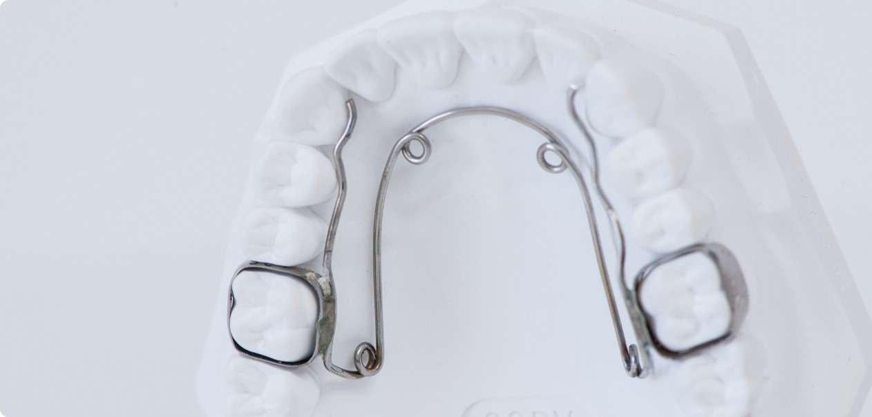 Dr Guedj Paris orthodontie quad helix