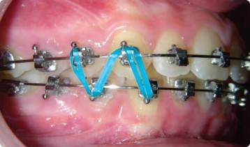 Dr Guedj Paris soin orthodontie elastiques