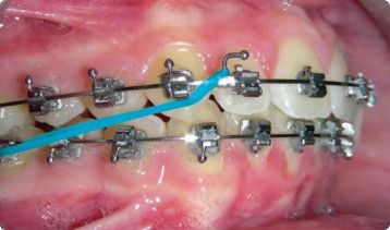 Dr Guedj Paris traitement orthodontie elastiques