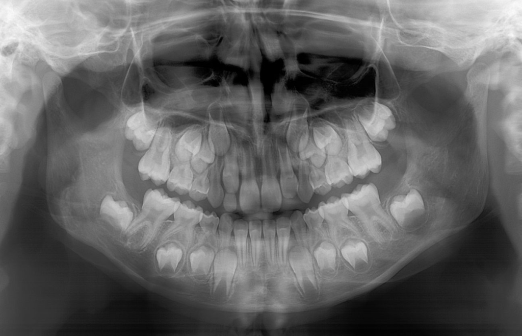 Dents de lait qui ne tombent pas – Faut-il s'inquiéter ?