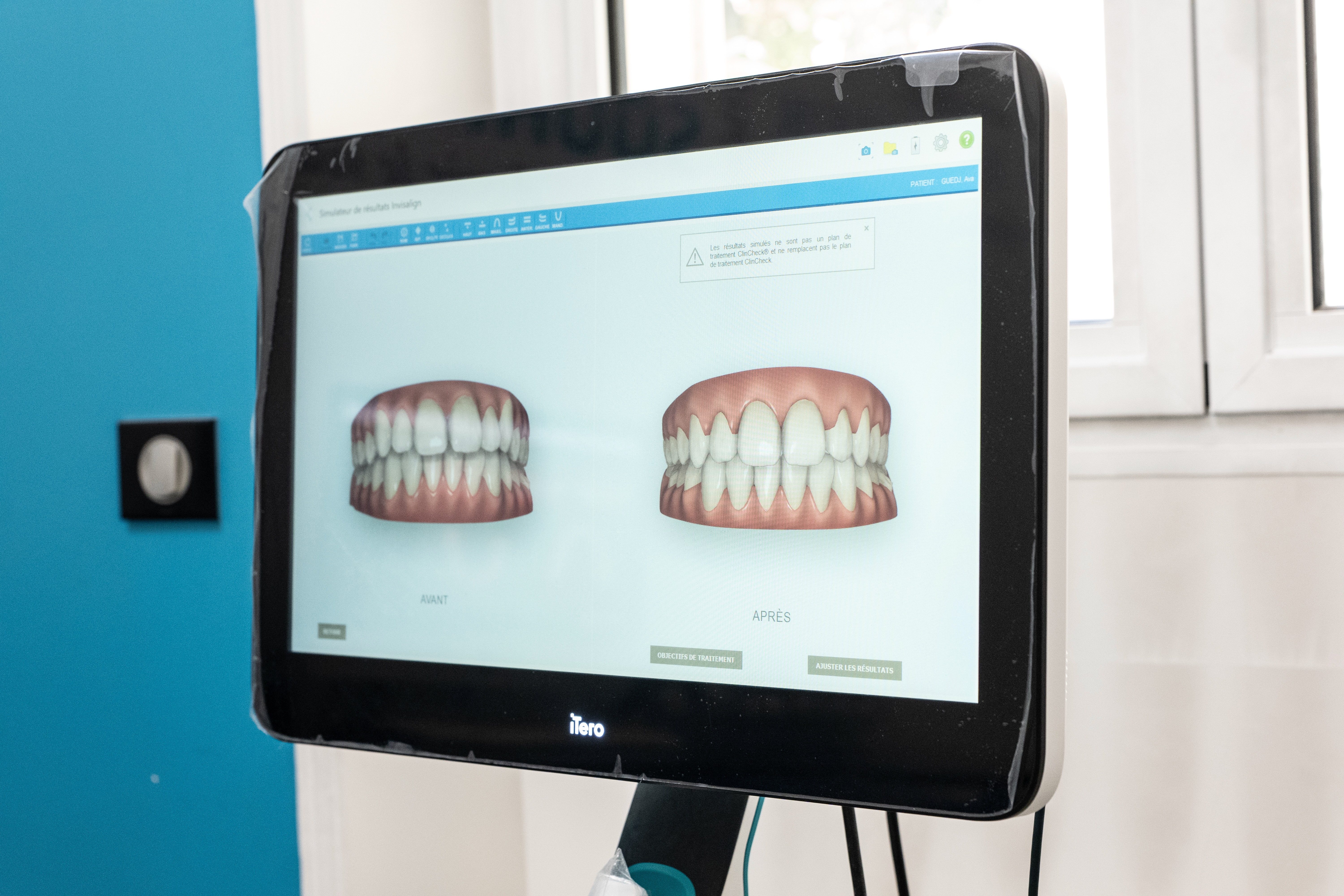 Simulation Sourire Orthodontie 3D | Cabinet Guedj