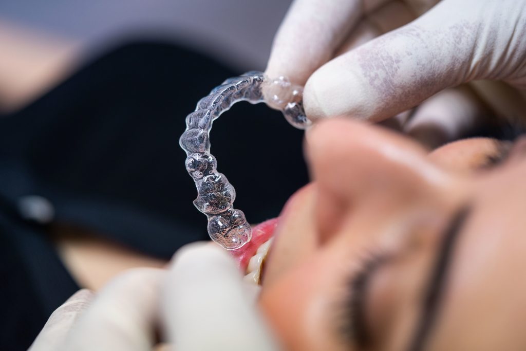 alignement dentaire adulte sans bague Alignement dentaire adulte sans bague | Docteur Olivier GUEDJ - Orthodontie Paris